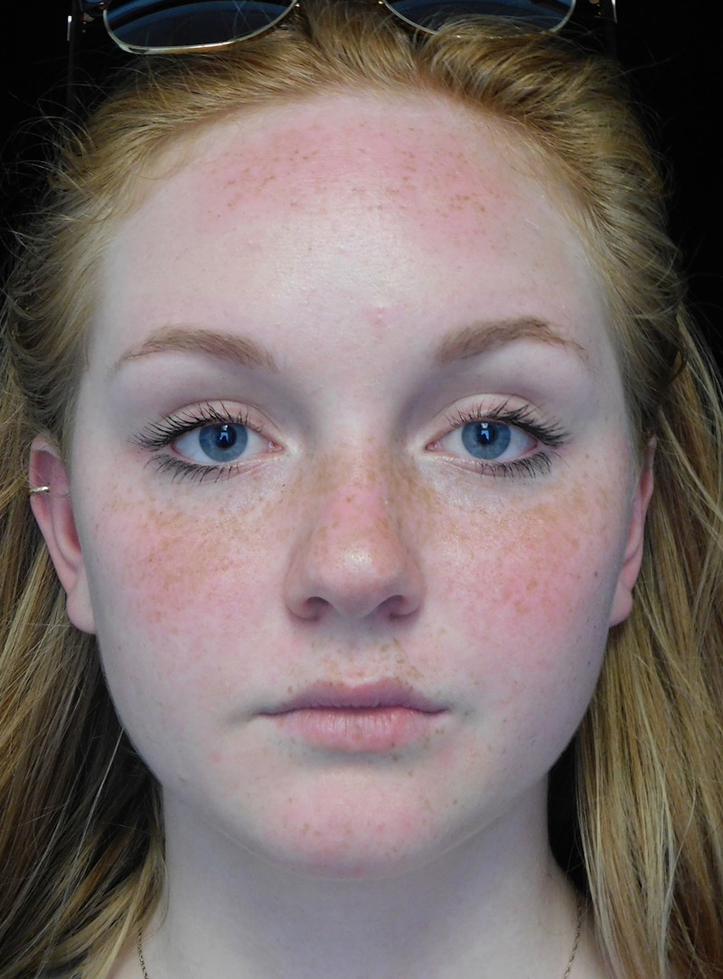 Beverly Hills Rhinoplasty Before & After Gallery - Patient 504445 - Image 3 Dr. Deepak Raj Dugar