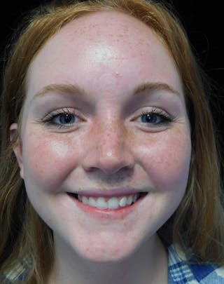 Beverly Hills Rhinoplasty Before & After Gallery - Patient 504445 - Image 6 Dr. Deepak Raj Dugar