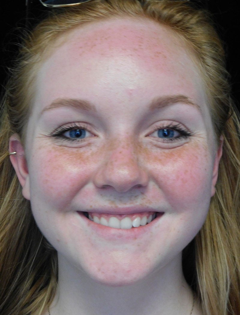 Beverly Hills Rhinoplasty Before & After Gallery - Patient 504445 - Image 5 Dr. Deepak Raj Dugar