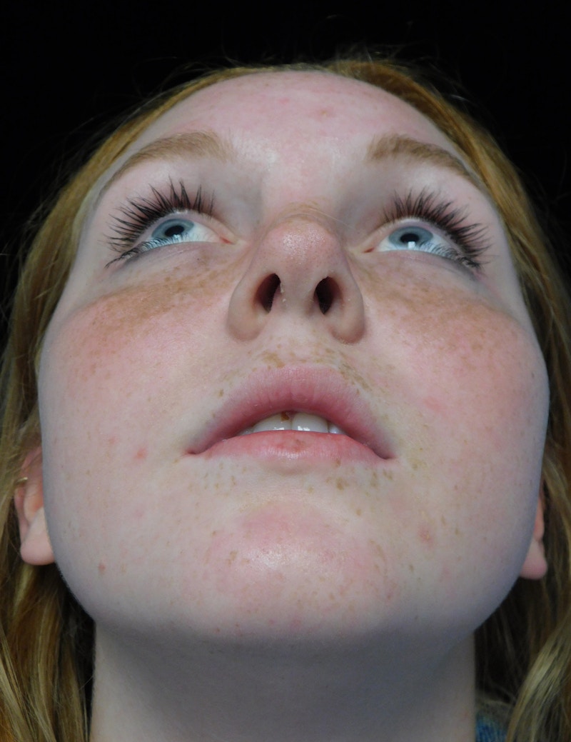 Beverly Hills Rhinoplasty Before & After Gallery - Patient 504445 - Image 7 Dr. Deepak Raj Dugar