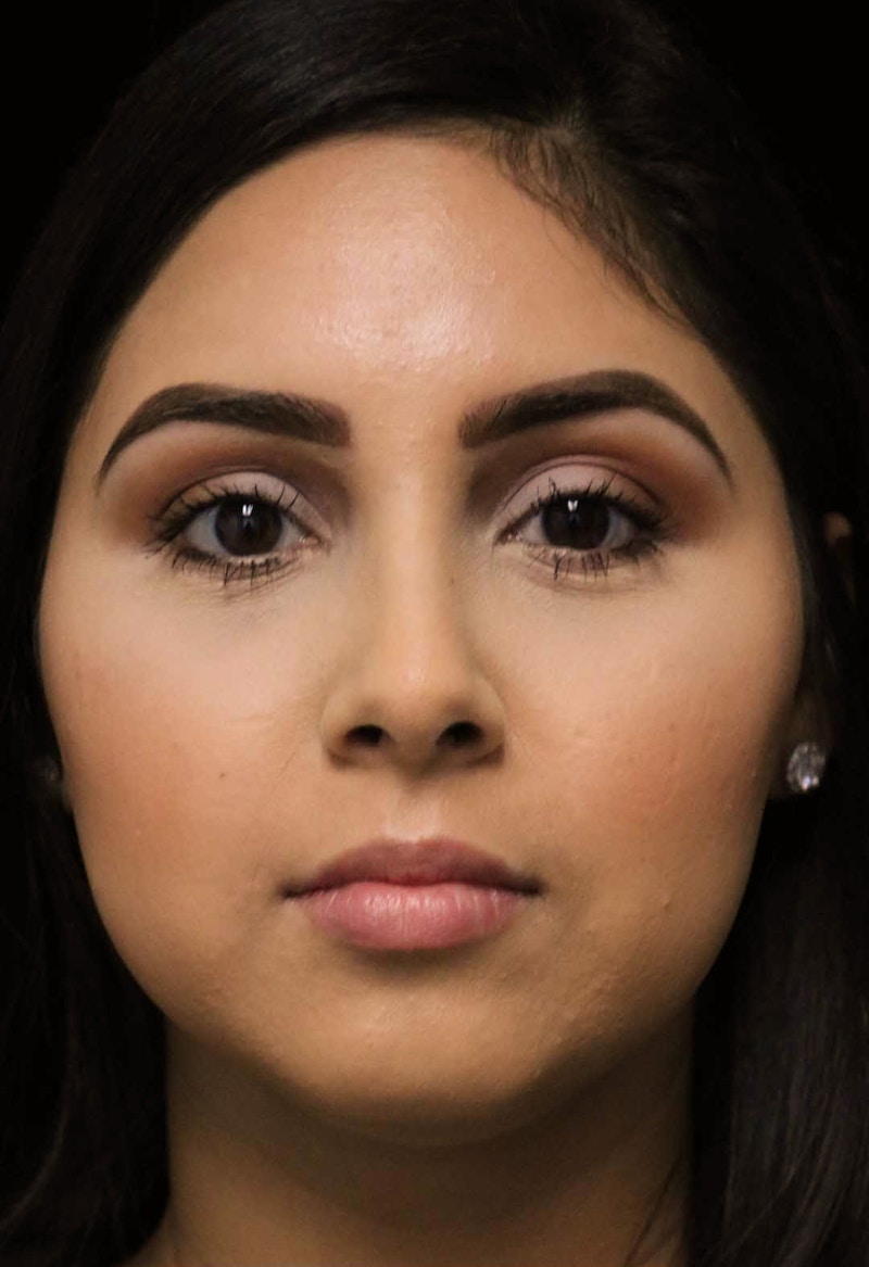 Beverly Hills Rhinoplasty Before & After Gallery - Patient 314428 - Image 4 Dr. Deepak Raj Dugar