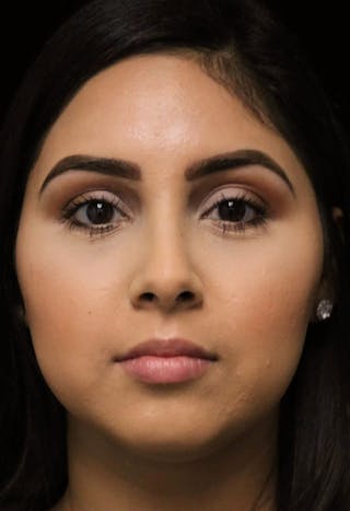 Beverly Hills Rhinoplasty Before & After Gallery - Patient 314428 - Image 4 Dr. Deepak Raj Dugar
