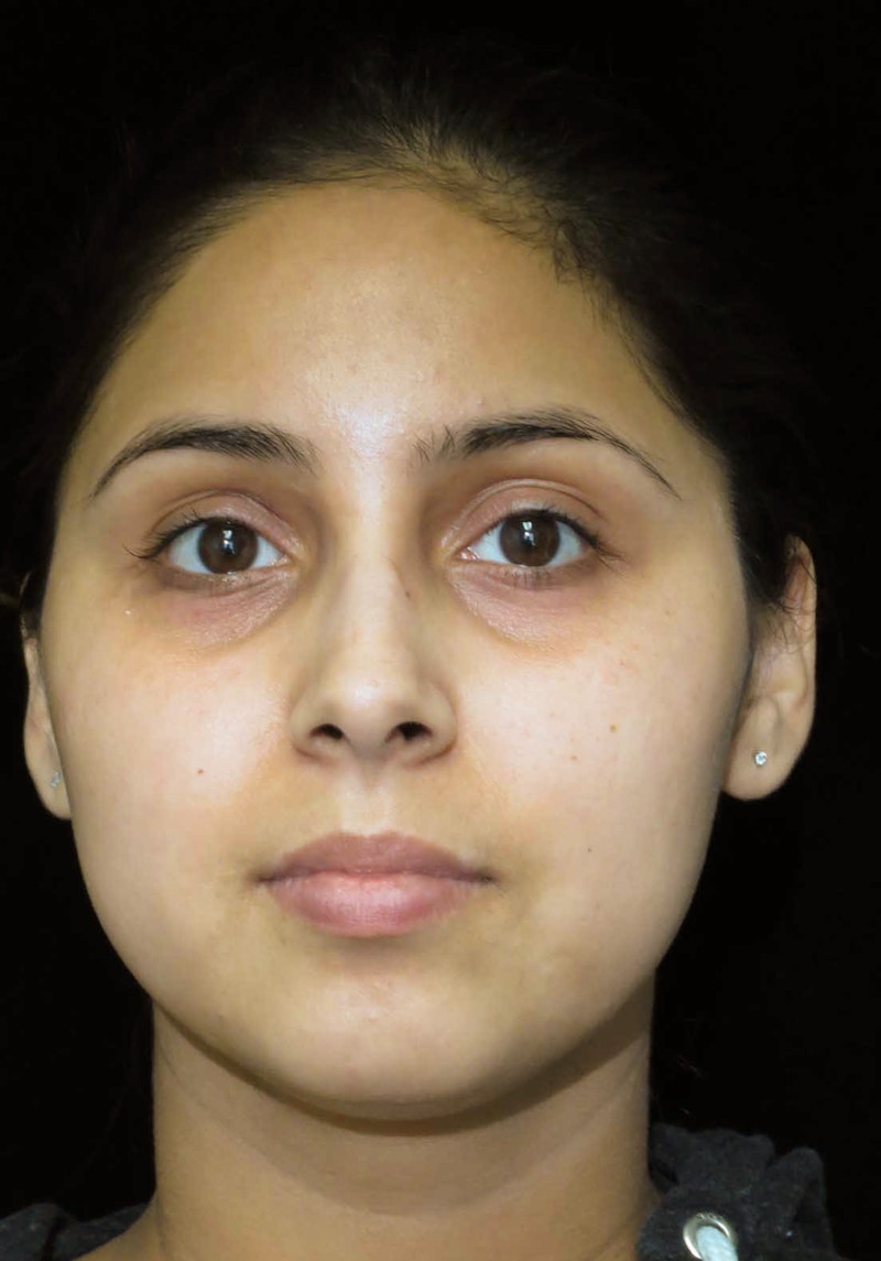 Beverly Hills Rhinoplasty Before & After Gallery - Patient 314428 - Image 3 Dr. Deepak Raj Dugar