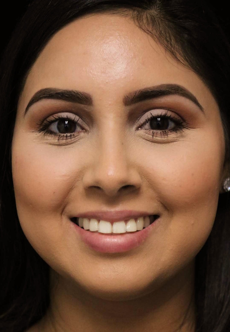 Beverly Hills Rhinoplasty Before & After Gallery - Patient 314428 - Image 6 Dr. Deepak Raj Dugar