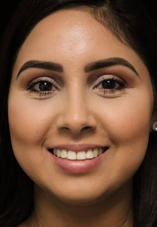 Beverly Hills Rhinoplasty Before & After Gallery - Patient 314428 - Image 6 Dr. Deepak Raj Dugar