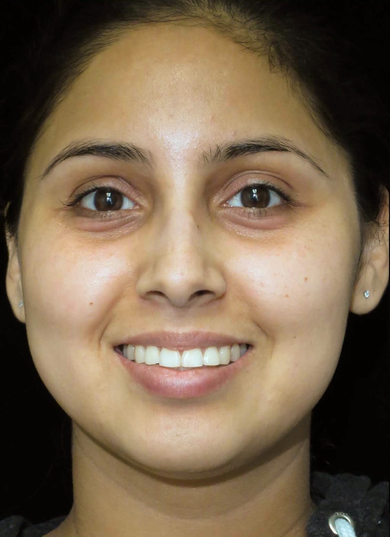 Beverly Hills Rhinoplasty Before & After Gallery - Patient 314428 - Image 5 Dr. Deepak Raj Dugar