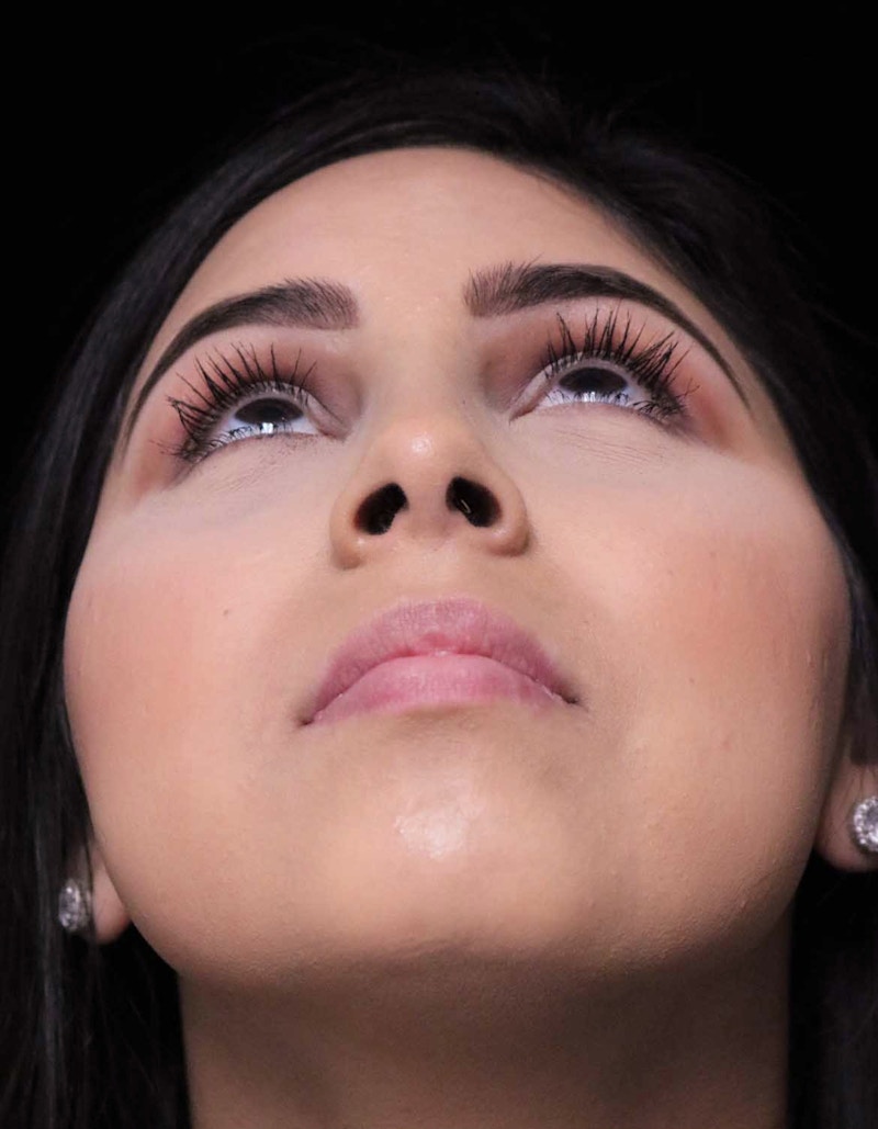 Beverly Hills Rhinoplasty Before & After Gallery - Patient 314428 - Image 8 Dr. Deepak Raj Dugar