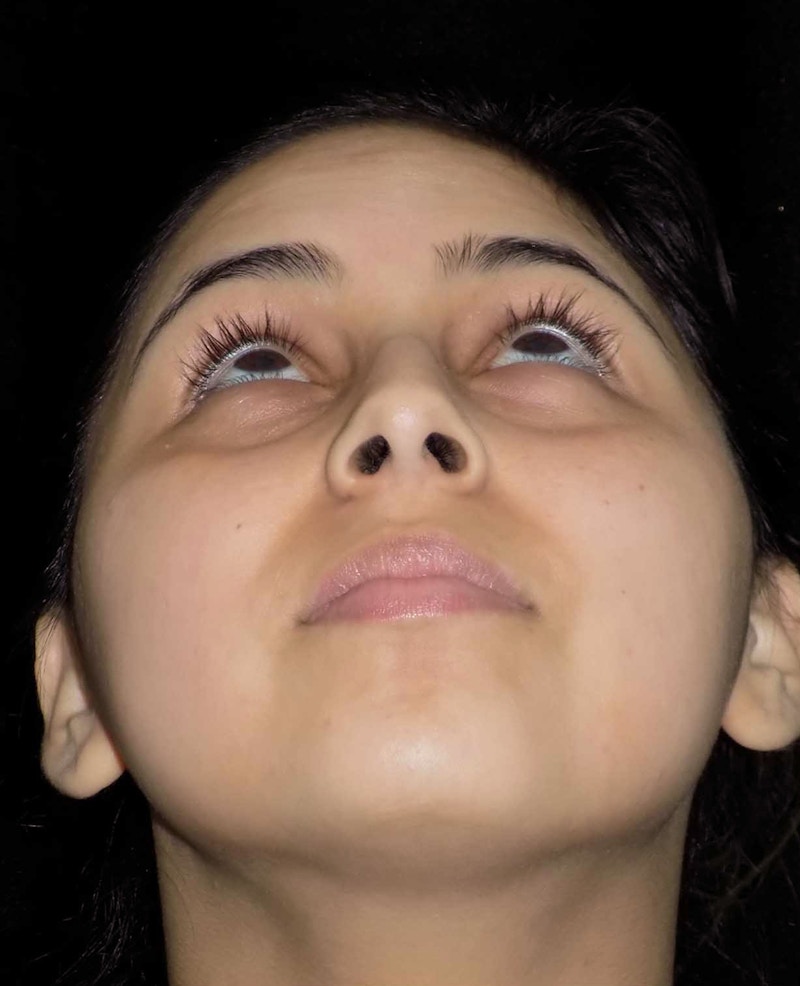 Beverly Hills Rhinoplasty Before & After Gallery - Patient 314428 - Image 7 Dr. Deepak Raj Dugar