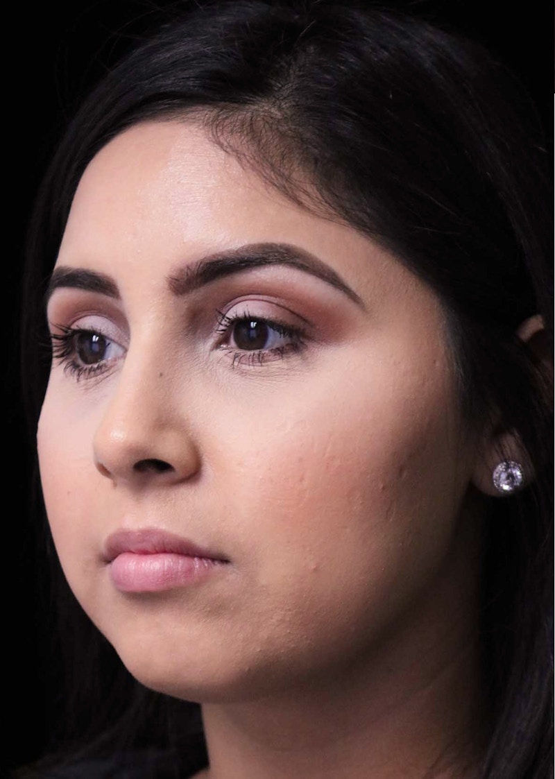 Beverly Hills Rhinoplasty Before & After Gallery - Patient 314428 - Image 10 Dr. Deepak Raj Dugar