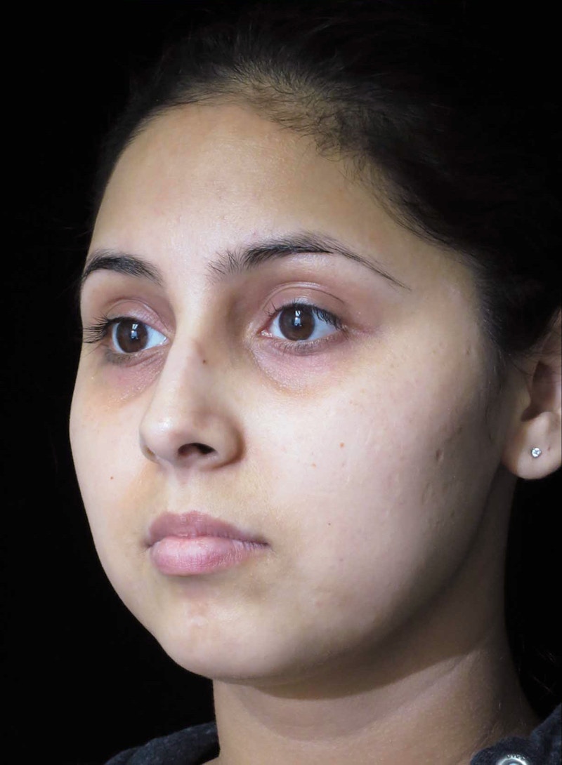 Beverly Hills Rhinoplasty Before & After Gallery - Patient 314428 - Image 9 Dr. Deepak Raj Dugar