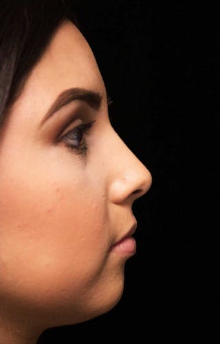 Beverly Hills Rhinoplasty Before & After Gallery - Patient 314428 - Image 2 Dr. Deepak Raj Dugar