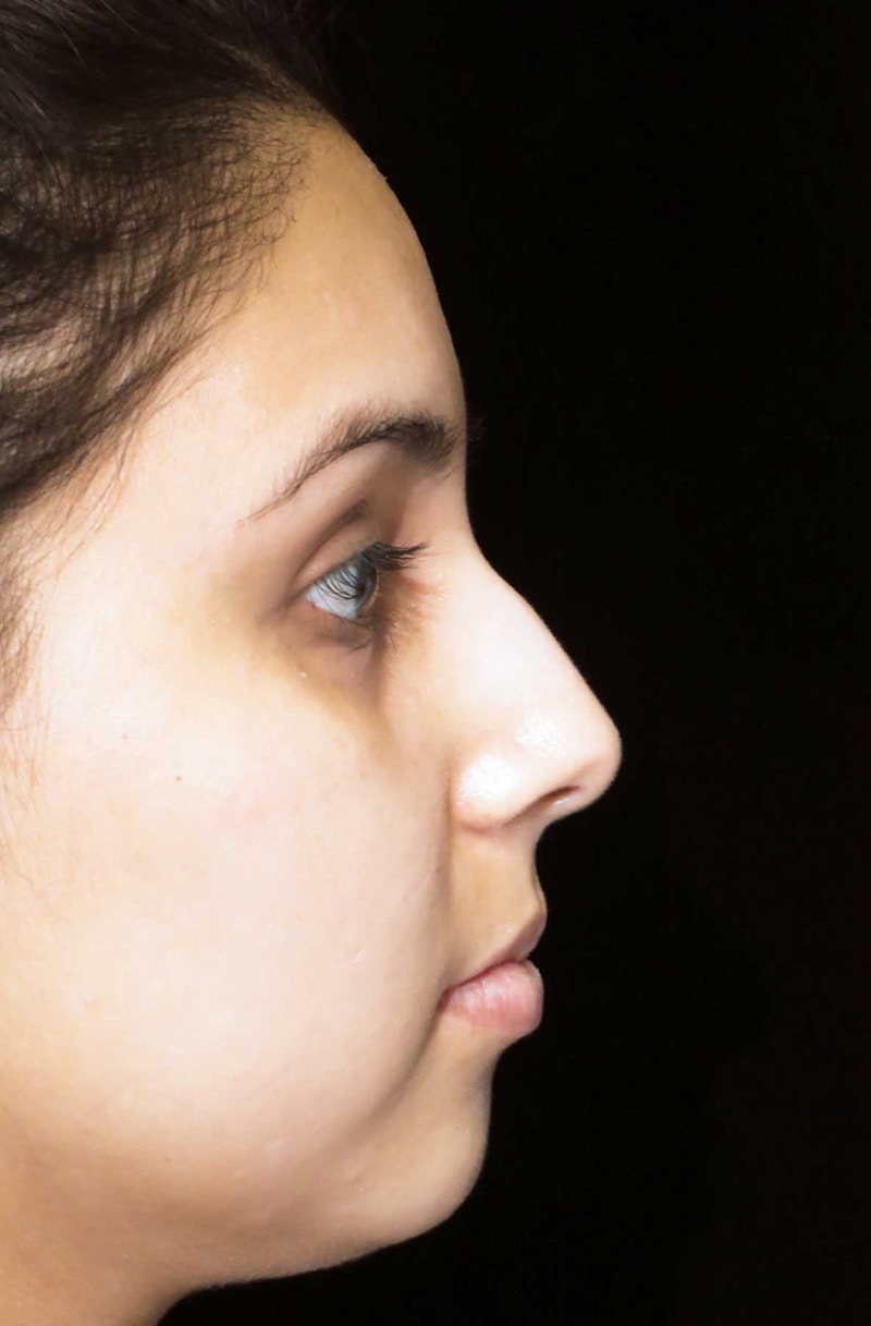 Beverly Hills Rhinoplasty Before & After Gallery - Patient 314428 - Image 1 Dr. Deepak Raj Dugar