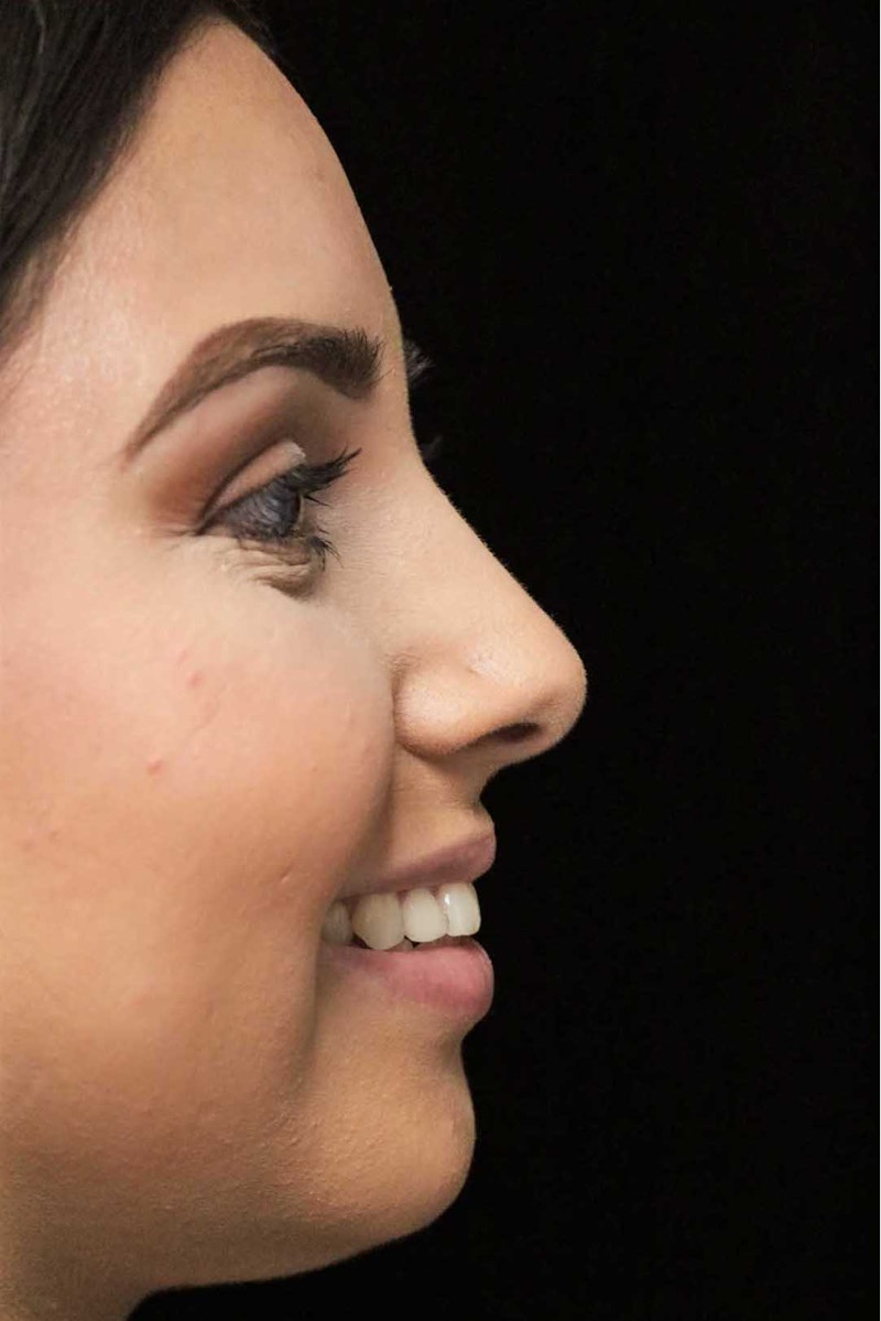 Beverly Hills Rhinoplasty Before & After Gallery - Patient 314428 - Image 12 Dr. Deepak Raj Dugar