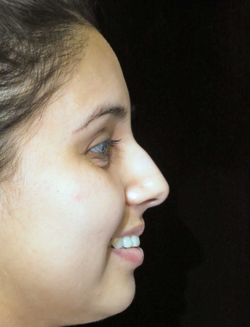 Beverly Hills Rhinoplasty Before & After Gallery - Patient 314428 - Image 11 Dr. Deepak Raj Dugar