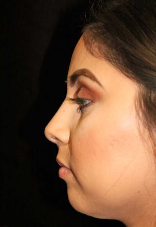 Beverly Hills Rhinoplasty Before & After Gallery - Patient 314428 - Image 14 Dr. Deepak Raj Dugar