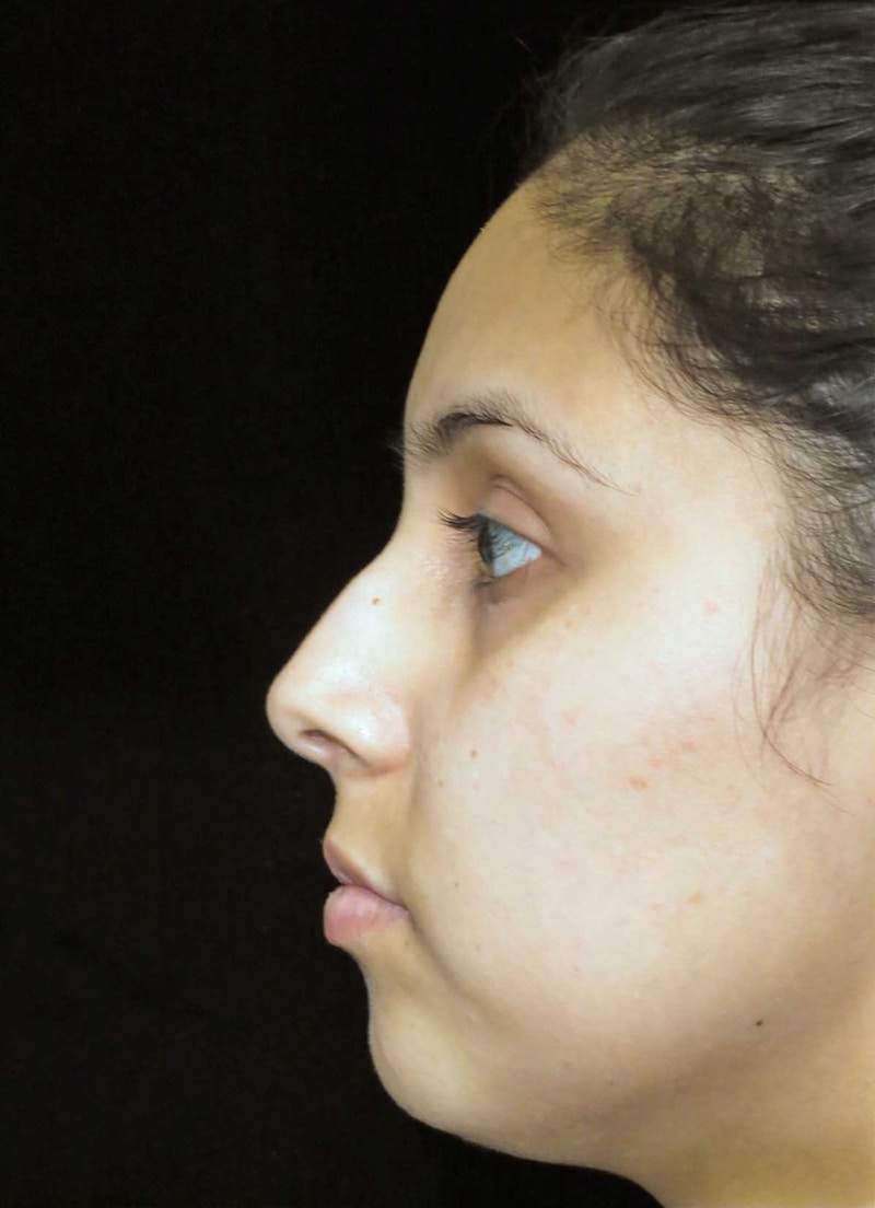 Beverly Hills Rhinoplasty Before & After Gallery - Patient 314428 - Image 13 Dr. Deepak Raj Dugar