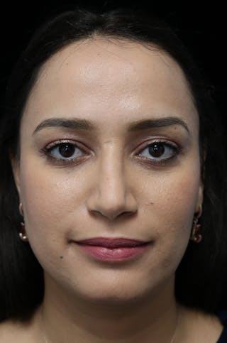 Beverly Hills Rhinoplasty Before & After Gallery - Patient 280745 - Image 4 Dr. Deepak Raj Dugar