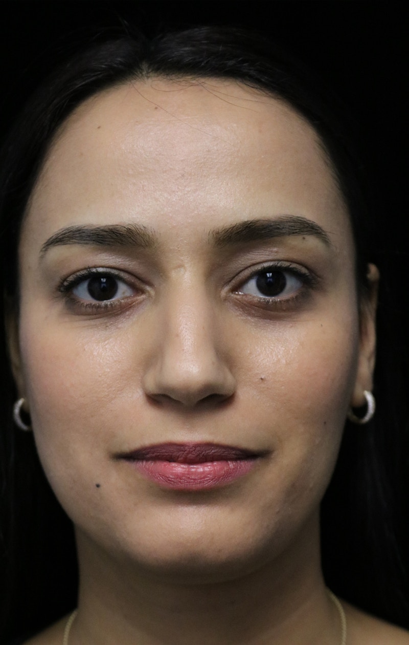 Beverly Hills Rhinoplasty Before & After Gallery - Patient 280745 - Image 3 Dr. Deepak Raj Dugar