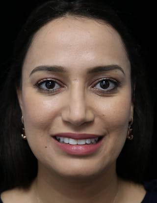 Beverly Hills Rhinoplasty Before & After Gallery - Patient 280745 - Image 6 Dr. Deepak Raj Dugar