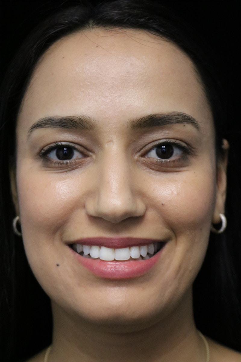 Beverly Hills Rhinoplasty Before & After Gallery - Patient 280745 - Image 5 Dr. Deepak Raj Dugar