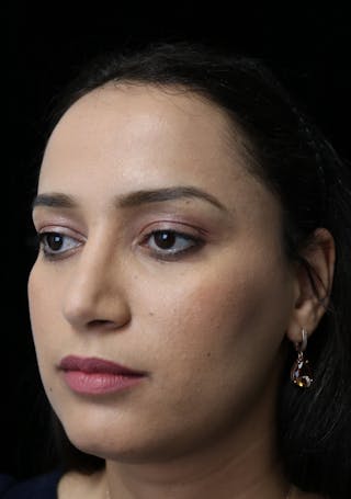 Beverly Hills Rhinoplasty Before & After Gallery - Patient 280745 - Image 10 Dr. Deepak Raj Dugar