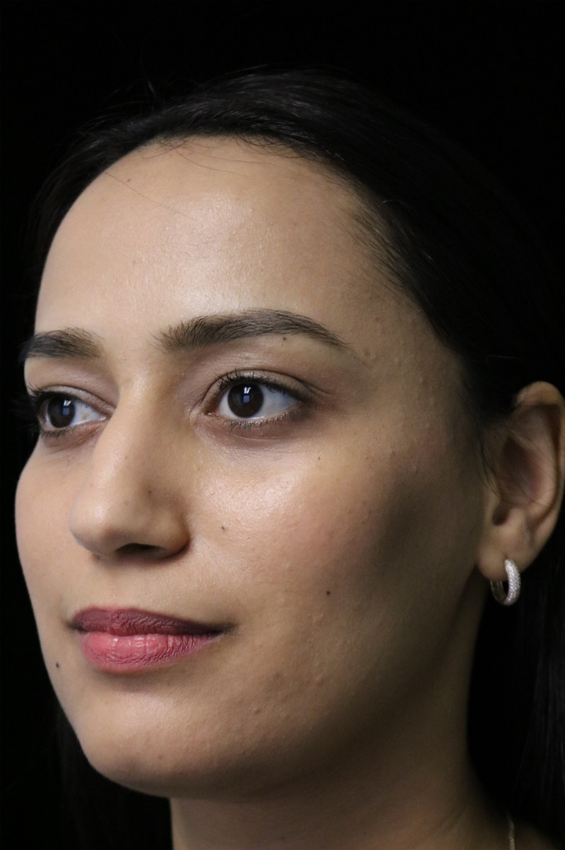 Beverly Hills Rhinoplasty Before & After Gallery - Patient 280745 - Image 9 Dr. Deepak Raj Dugar
