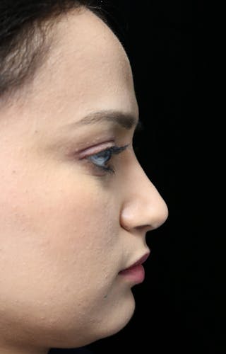 Beverly Hills Rhinoplasty Before & After Gallery - Patient 280745 - Image 2 Dr. Deepak Raj Dugar