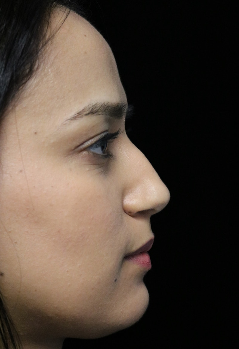 Beverly Hills Rhinoplasty Before & After Gallery - Patient 280745 - Image 1 Dr. Deepak Raj Dugar