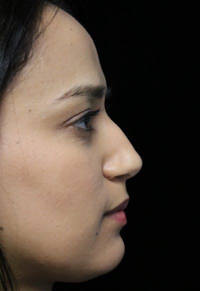 Beverly Hills Rhinoplasty Before & After Gallery - Patient 280745 - Image 1 Dr. Deepak Raj Dugar