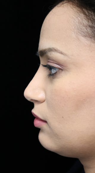 Beverly Hills Rhinoplasty Before & After Gallery - Patient 280745 - Image 12 Dr. Deepak Raj Dugar
