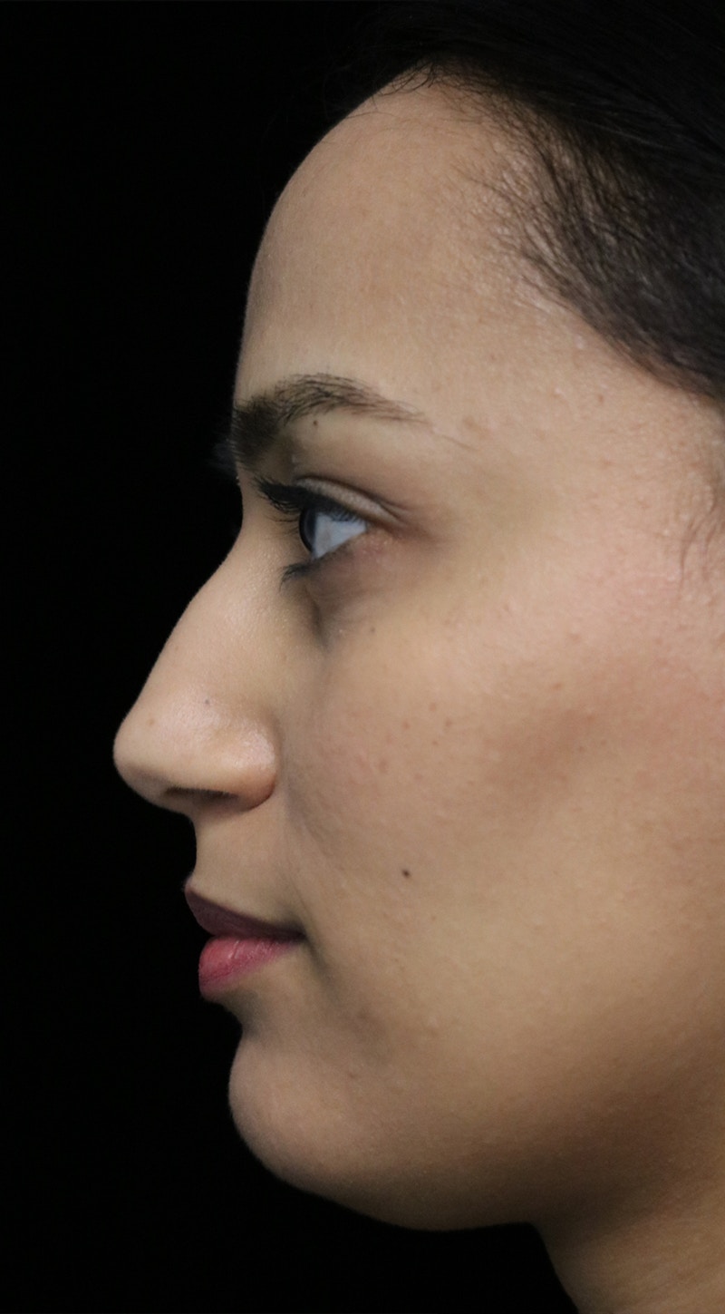 Beverly Hills Rhinoplasty Before & After Gallery - Patient 280745 - Image 11 Dr. Deepak Raj Dugar