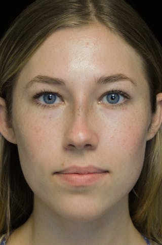 Beverly Hills Rhinoplasty Before & After Gallery - Patient 349842 - Image 4 Dr. Deepak Raj Dugar