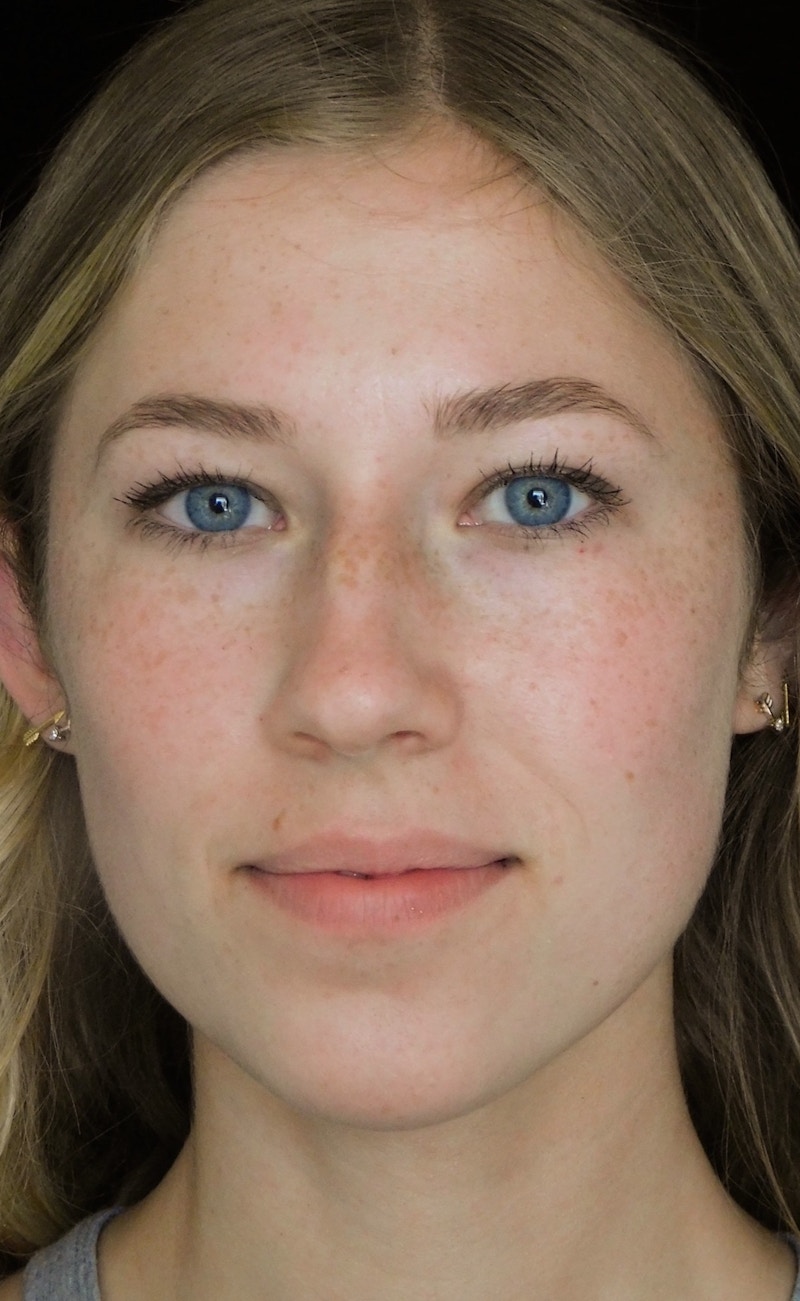 Beverly Hills Rhinoplasty Before & After Gallery - Patient 349842 - Image 3 Dr. Deepak Raj Dugar