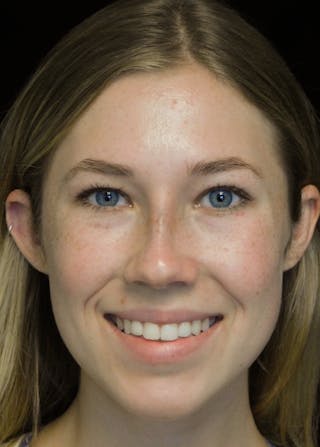 Beverly Hills Rhinoplasty Before & After Gallery - Patient 349842 - Image 6 Dr. Deepak Raj Dugar