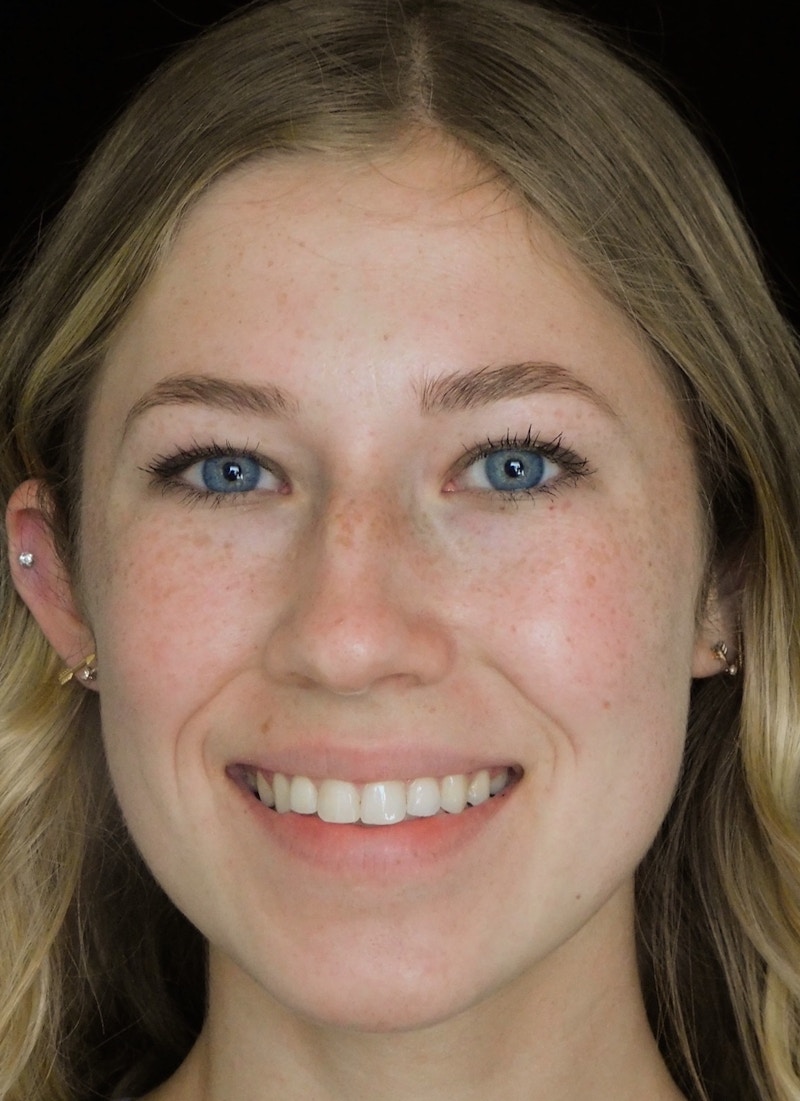 Beverly Hills Rhinoplasty Before & After Gallery - Patient 349842 - Image 5 Dr. Deepak Raj Dugar