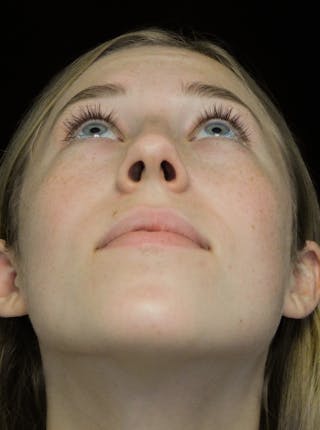 Beverly Hills Rhinoplasty Before & After Gallery - Patient 349842 - Image 8 Dr. Deepak Raj Dugar