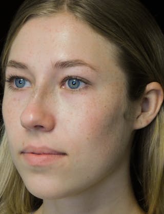 Beverly Hills Rhinoplasty Before & After Gallery - Patient 349842 - Image 10 Dr. Deepak Raj Dugar