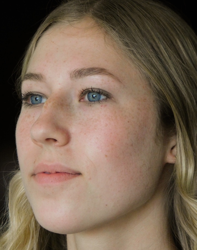 Beverly Hills Rhinoplasty Before & After Gallery - Patient 349842 - Image 9 Dr. Deepak Raj Dugar
