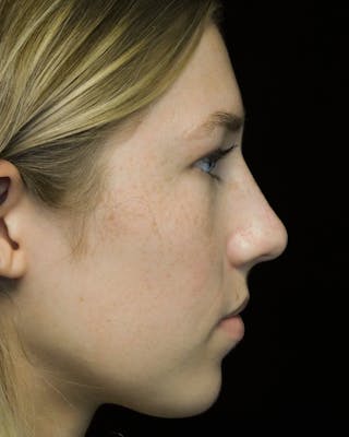 Beverly Hills Rhinoplasty Before & After Gallery - Patient 349842 - Image 2 Dr. Deepak Raj Dugar