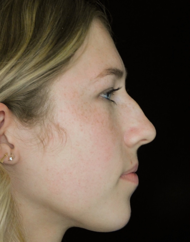 Beverly Hills Rhinoplasty Before & After Gallery - Patient 349842 - Image 1 Dr. Deepak Raj Dugar
