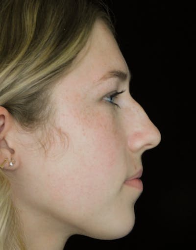 Beverly Hills Rhinoplasty Before & After Gallery - Patient 349842 - Image 1 Dr. Deepak Raj Dugar