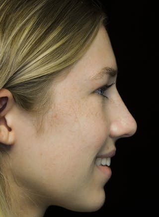 Beverly Hills Rhinoplasty Before & After Gallery - Patient 349842 - Image 12 Dr. Deepak Raj Dugar