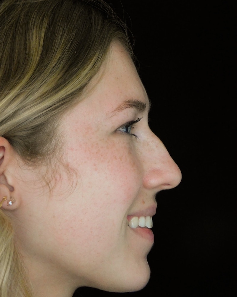 Beverly Hills Rhinoplasty Before & After Gallery - Patient 349842 - Image 11 Dr. Deepak Raj Dugar