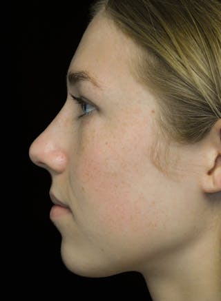 Beverly Hills Rhinoplasty Before & After Gallery - Patient 349842 - Image 14 Dr. Deepak Raj Dugar