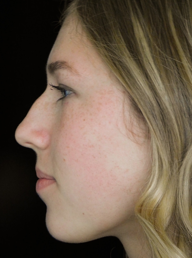 Beverly Hills Rhinoplasty Before & After Gallery - Patient 349842 - Image 13 Dr. Deepak Raj Dugar