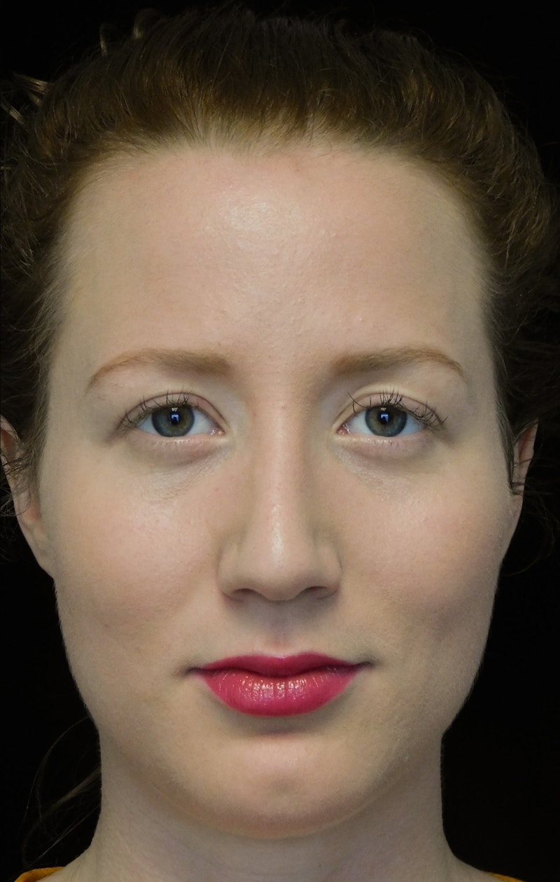 Beverly Hills Rhinoplasty Before & After Gallery - Patient 244673 - Image 4 Dr. Deepak Raj Dugar
