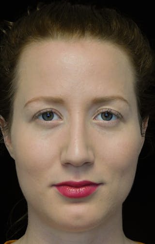 Beverly Hills Rhinoplasty Before & After Gallery - Patient 244673 - Image 4 Dr. Deepak Raj Dugar