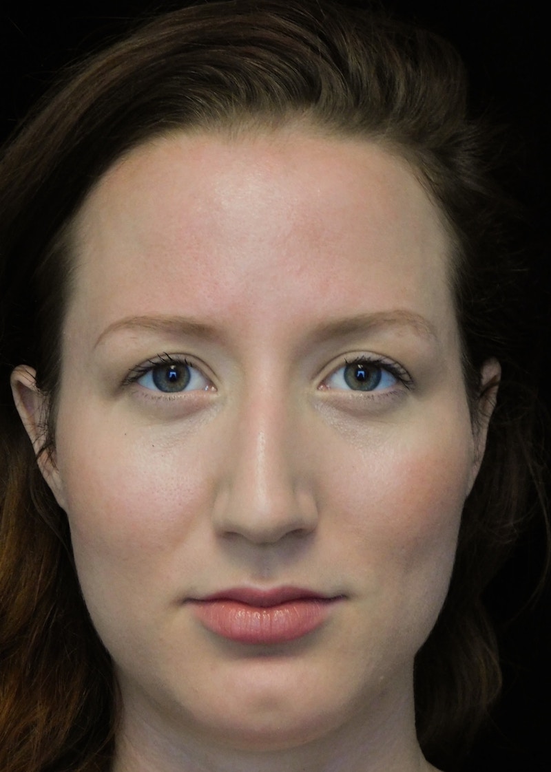 Beverly Hills Rhinoplasty Before & After Gallery - Patient 244673 - Image 3 Dr. Deepak Raj Dugar
