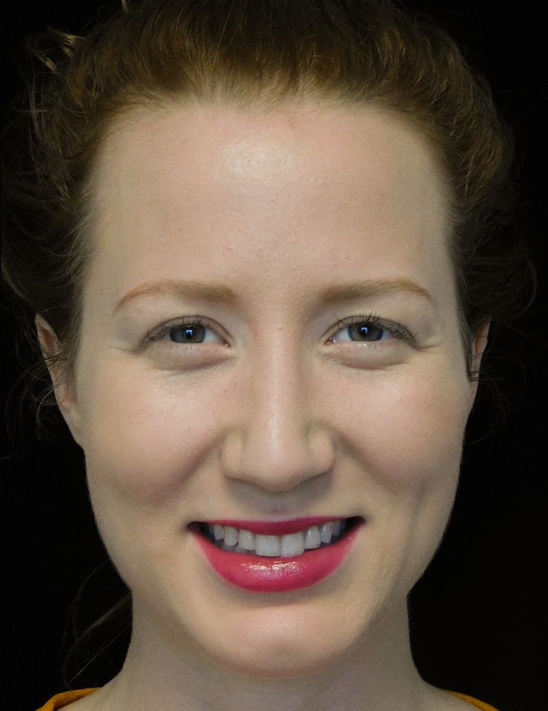 Beverly Hills Rhinoplasty Before & After Gallery - Patient 244673 - Image 6 Dr. Deepak Raj Dugar