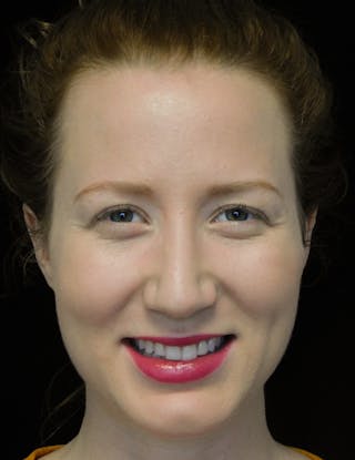 Beverly Hills Rhinoplasty Before & After Gallery - Patient 244673 - Image 6 Dr. Deepak Raj Dugar